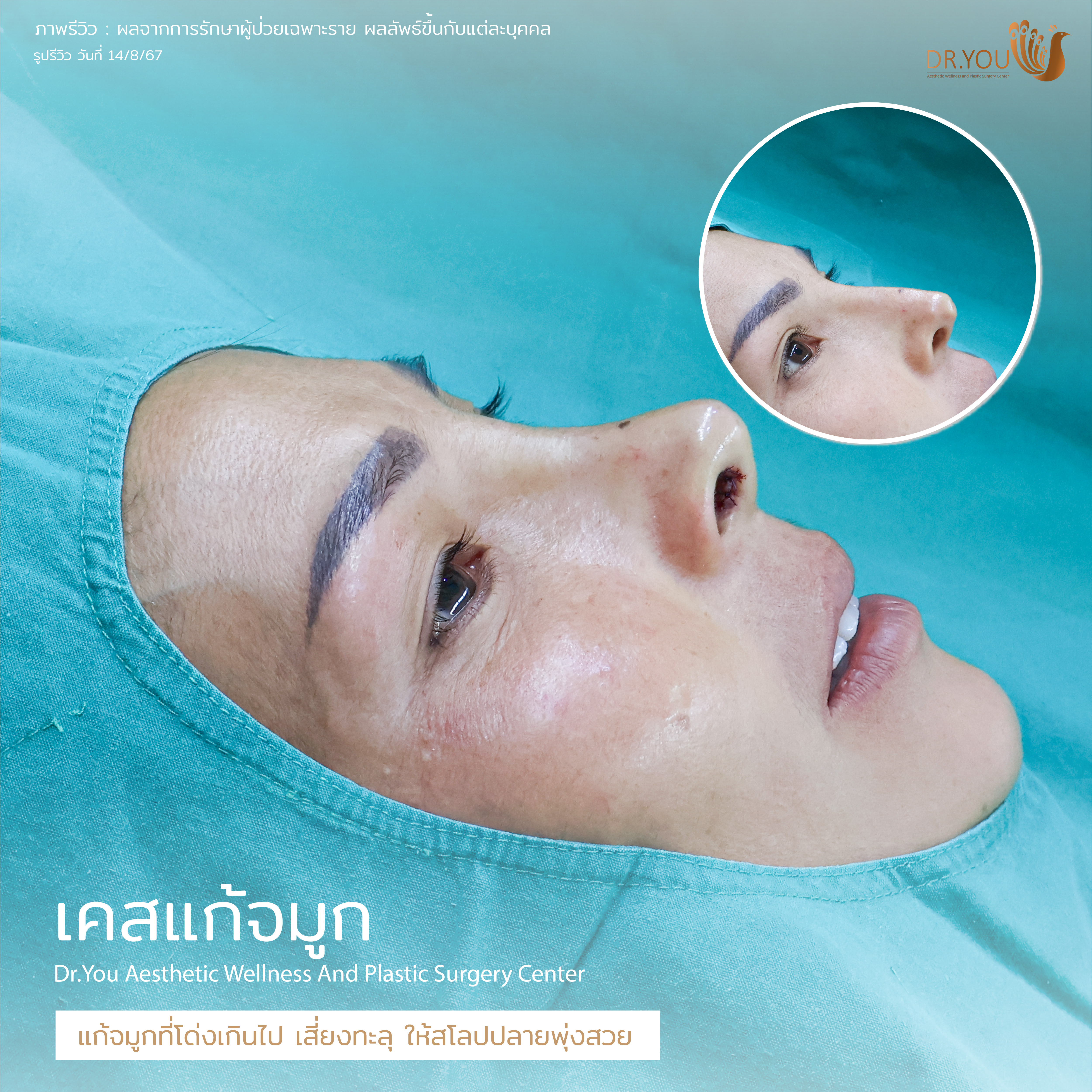 รีวิวหลังเสริมจมูกทันที