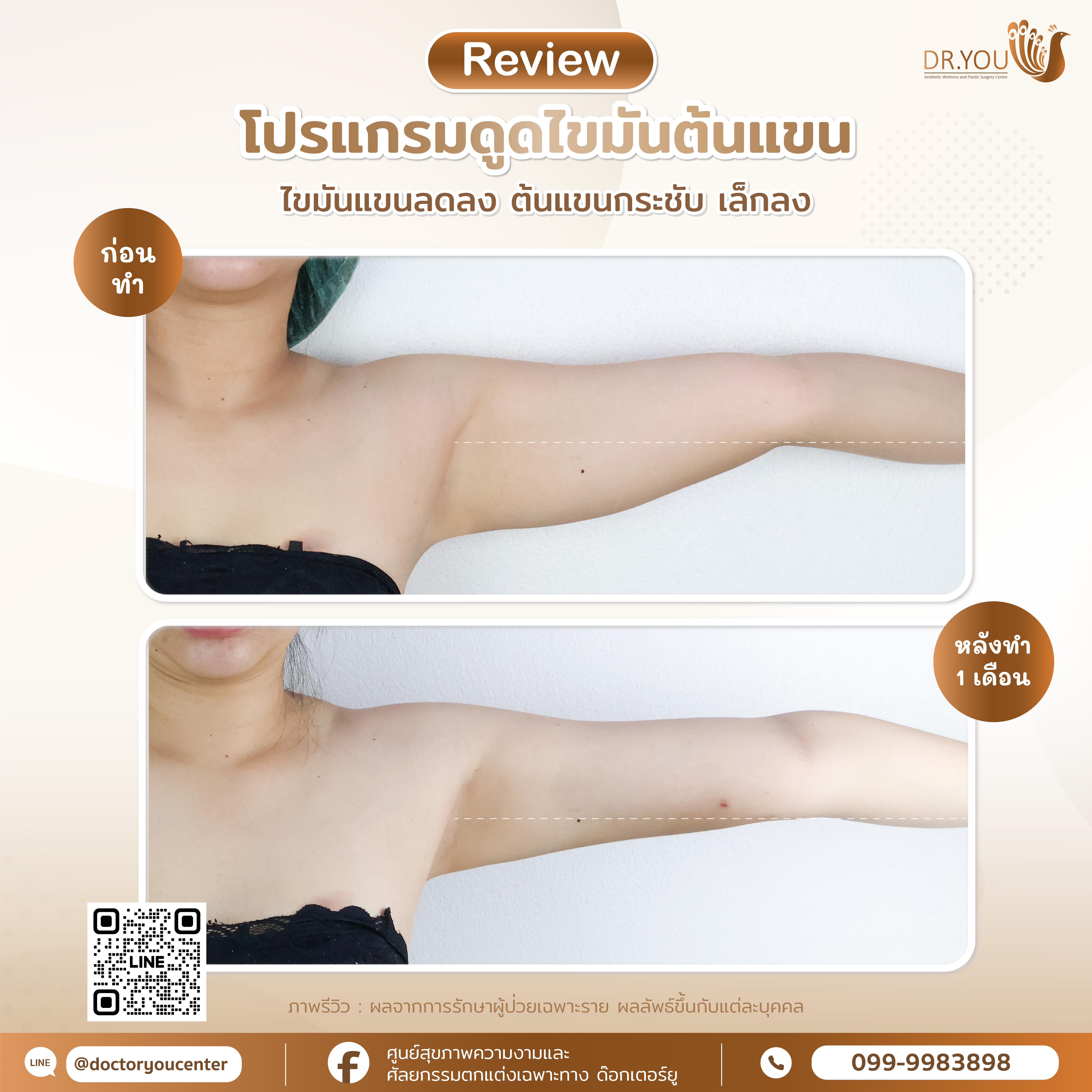 รีวิวดูดไขมัน